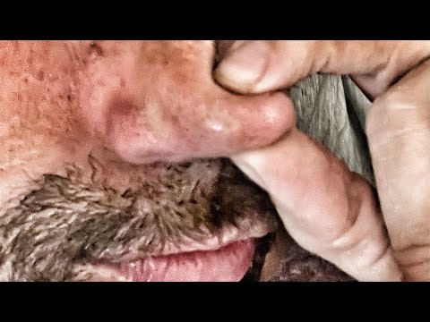 Blackhead King! Week in Review