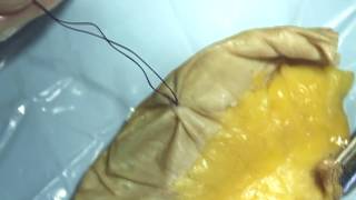 Suturing the small intestine defect with a purse string suture