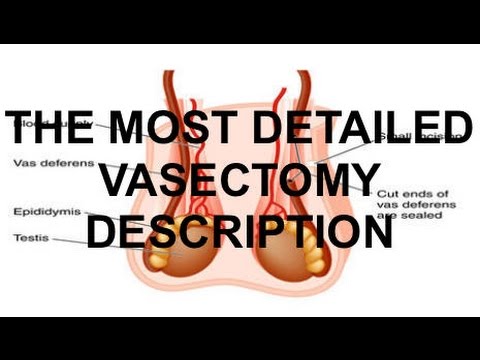 Vasectomy | What to Expect Before, During and After the Vasectomy | Tiger Fitness