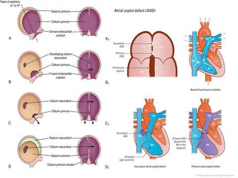 Defek Septum Atrium (Atrial Septal Defect) | Kardiologi | Anak | Materi Kedokteran