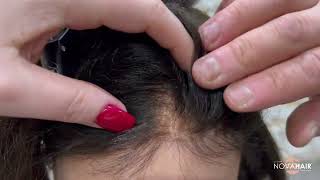 Kemoterapide Saç Dökülmesini Dert Etmeyin Nova Hair 32 Yıldır En Doğal Çözümler Ile Yanınızda
