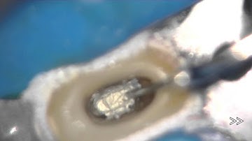 Root canal filling using MTA cement