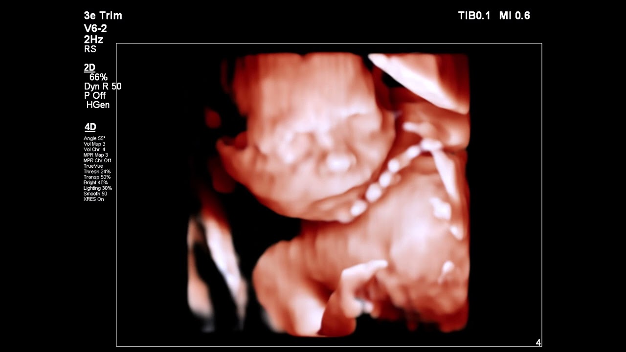 4D Echofoto's 23 Weken Zwanger