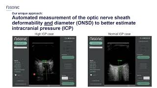 Nisonic - the physiology and principles for non-invasive measurement of ICP