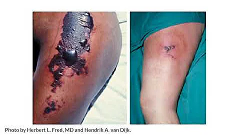 01.11 IV Complications