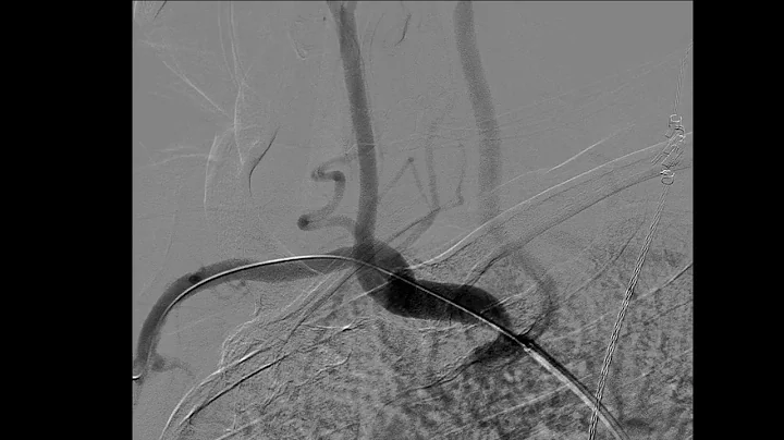 brachiocephalic stent angioplasty