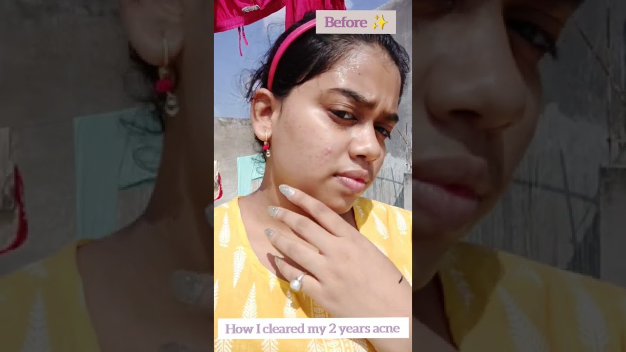 How I cleared My 2 years ACNE!|My Honest Acne Journey|