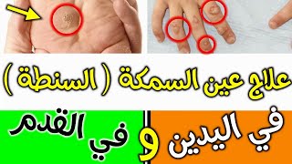 علاج عين السمكه ( طريقة علاج عين السمكة في يوم واحد مع الحذر من استخدام المواد المطلوبة )