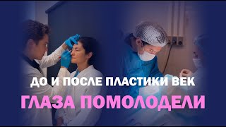 Круговая блефаропластика: реальный результат через месяц!