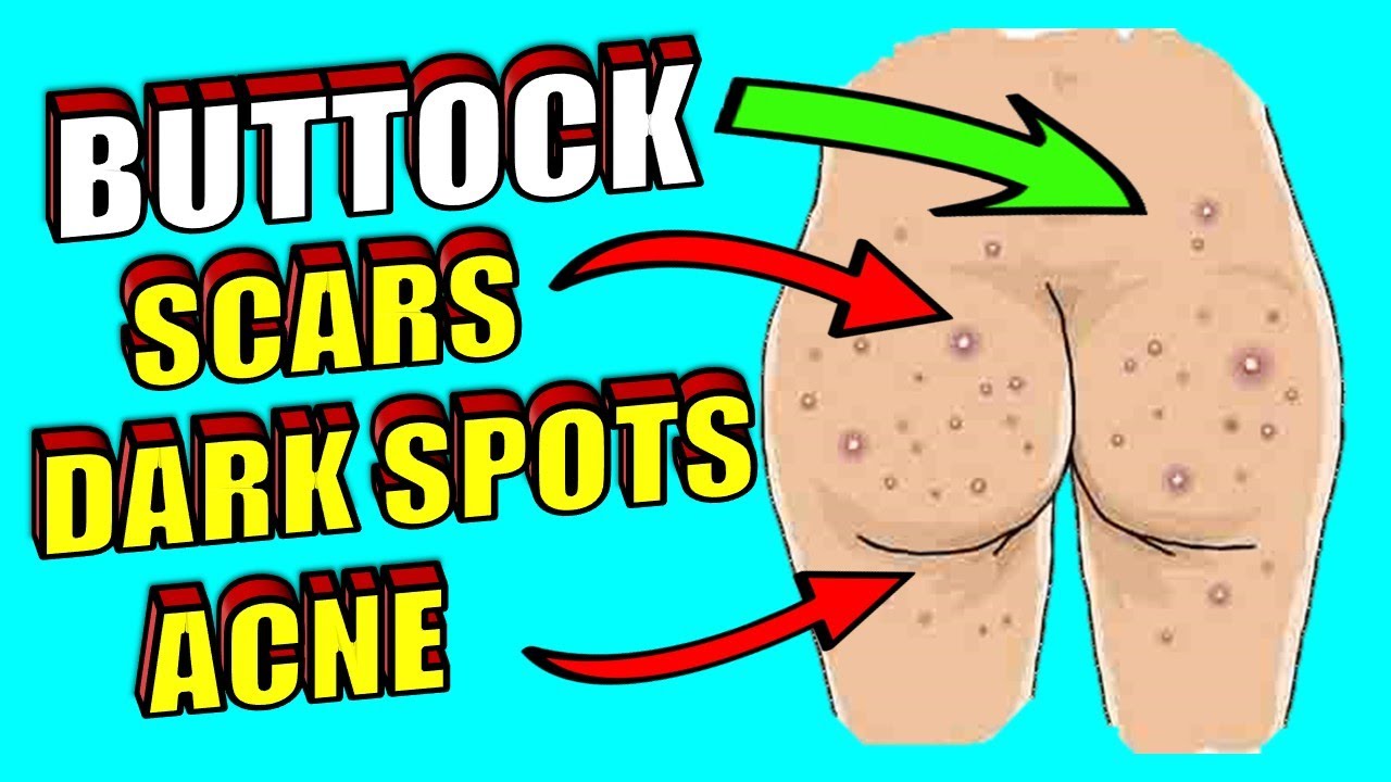 How to Get Rid of Buttock Scars, Dark Spots and Acne Naturally 