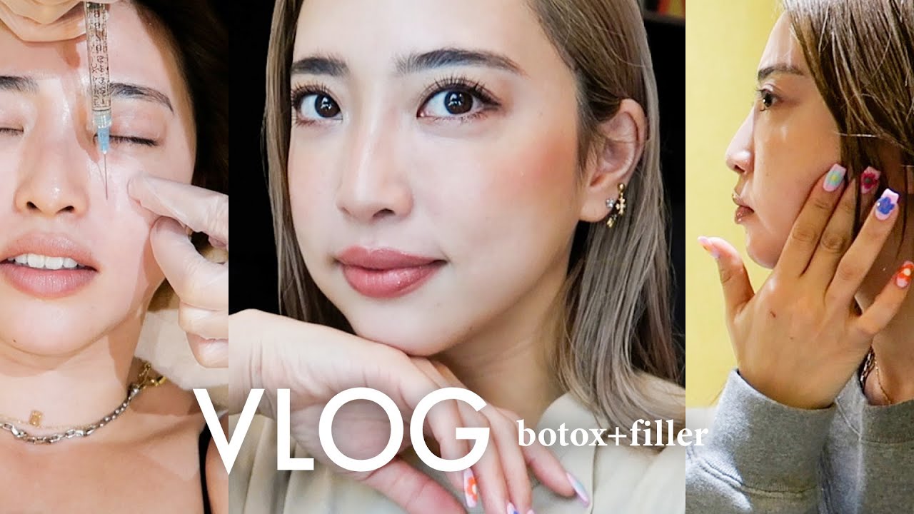 【美容施術】人生初ボトックス注射とヒアルロン酸！施術当日〜2週間のレポ✍️