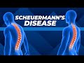 Top Three Exercises for Scheuermann's Disease