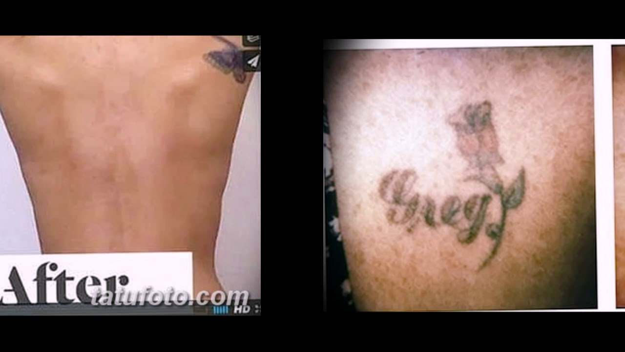 После тату купался. Сведение тату до и после. Вывод Татуировки лазером. Удаление тату до и после.