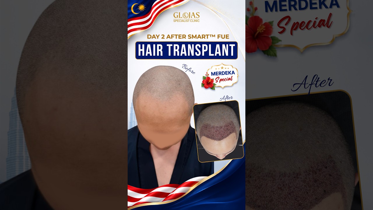 Hair Transplant Malaysia l Pakar Tanam Rambut l Day 2 After SMART™ FUE! 🌱 #hairtransplantmalaysia
