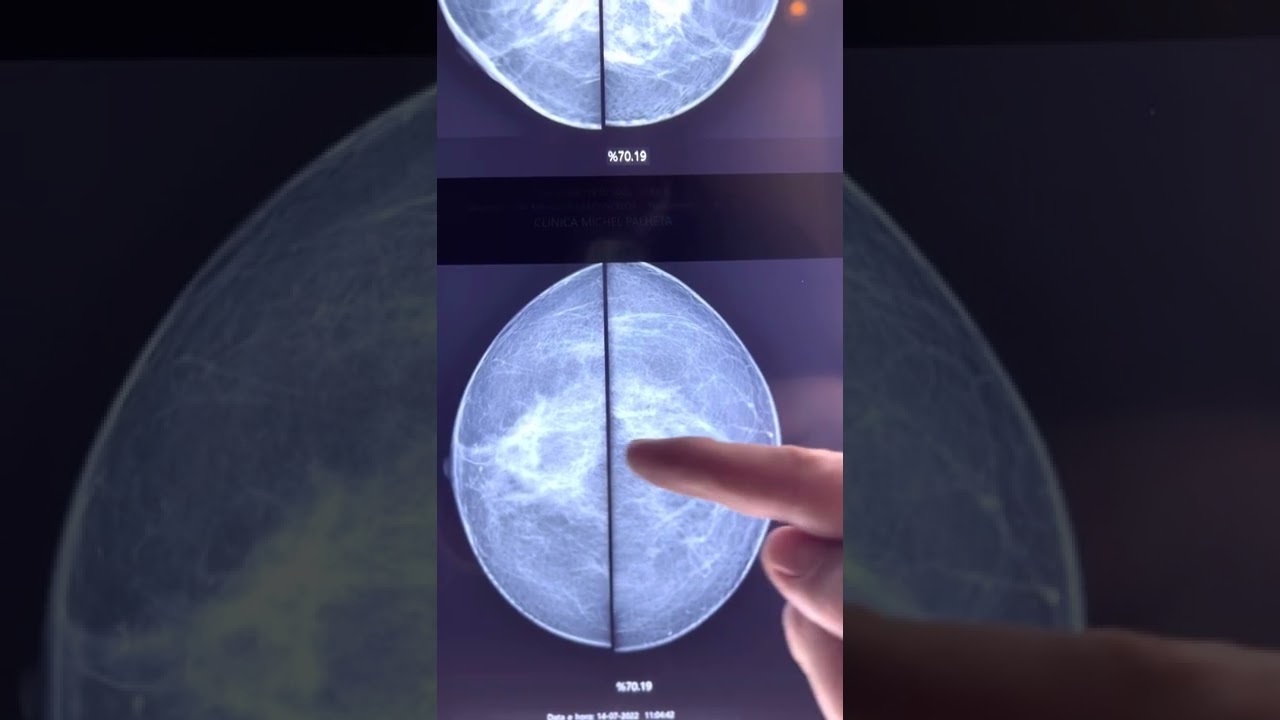 Como aparece o câncer na mamografia?