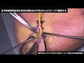 動画2　手根管症候群に対する神経剥離術