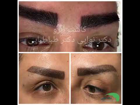 کاشت ابرو با دستگاه اتوماتیک کلینیک تخصصی دکتر نوایی