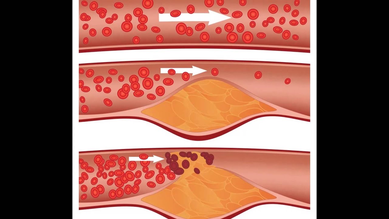 cholesterol medications | New Drug May Help Lower 'Bad ...