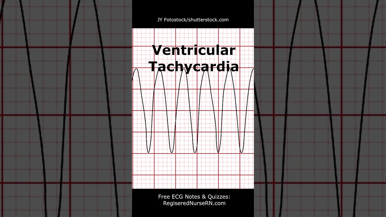 ECG EKG Heart Rhythms POP Quiz Can You Identify These Shorts Ecg Nursing