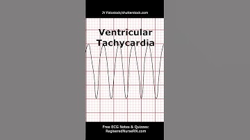 ECG (EKG) Heart Rhythms POP Quiz: Can You Identify These Heart Rhythms? #shorts #ecg #nursing