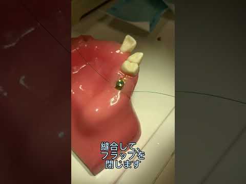 インプラント治療のセカンドステージ　2次オペとは何だ⁉️