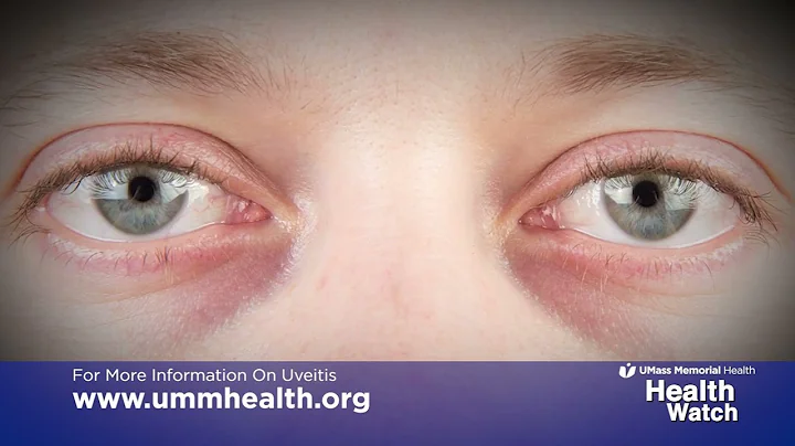 Health Watch: Uveitis Causes and Treatment
