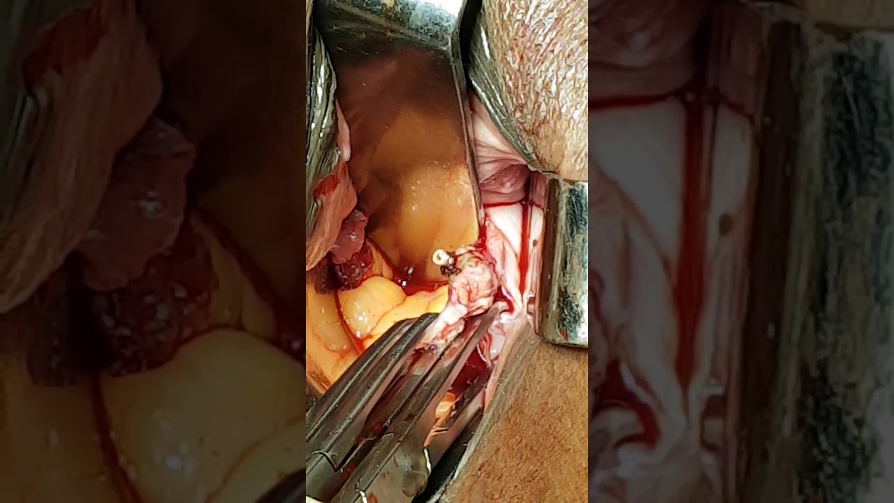 Purohit Technique Of Vaginal Hysterectomy