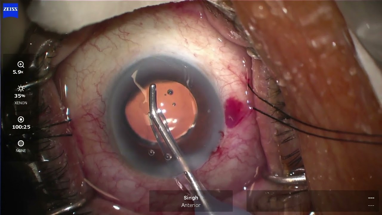 HYDRUS MICROSTENT - AWESOME BLANCHING-  I Paul Singh, MD