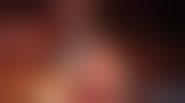 Right Laparoscopic Partial Nephrectomy | Dr Shyam Varma