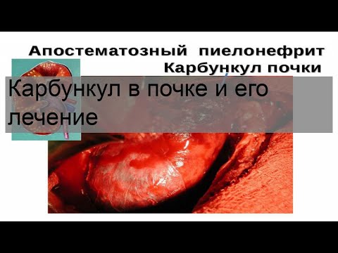 Карбункул в почке и его лечение