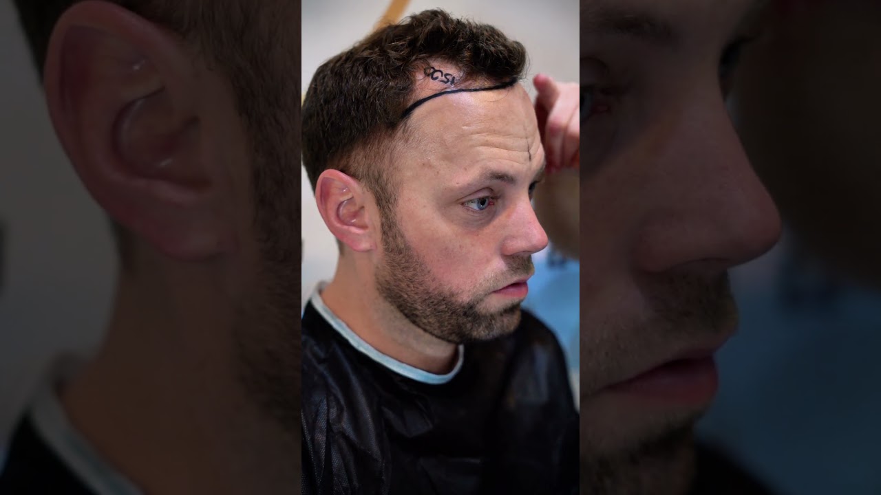 Client’s Hair Transformation in Turkey | Istanbul Care Hair Transplant Process