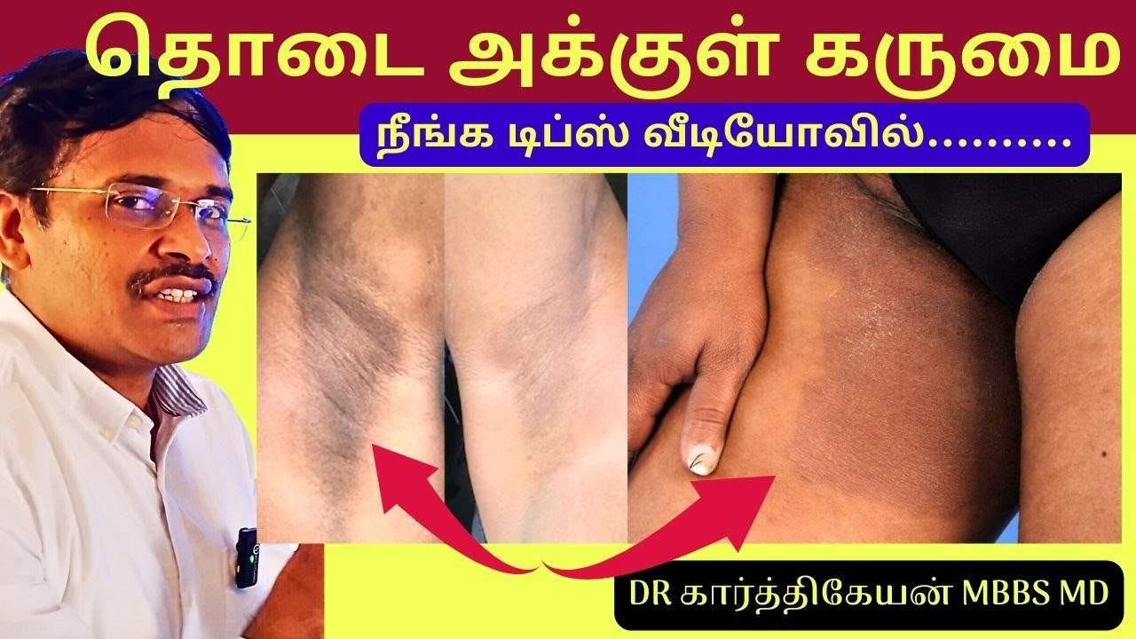       black patches dark skin removal  Home Remedies