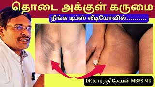 தொடை அக்குள் கருமை நீங்க டிப்ஸ் | black patches dark skin removal | Home Remedies