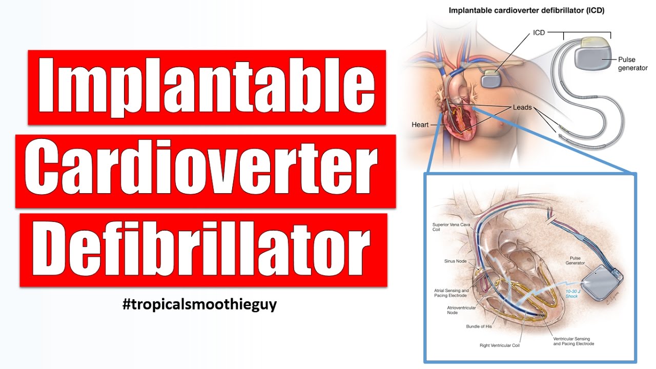 how an implantable cardioverter defibrillator works youtube how defibrillator works