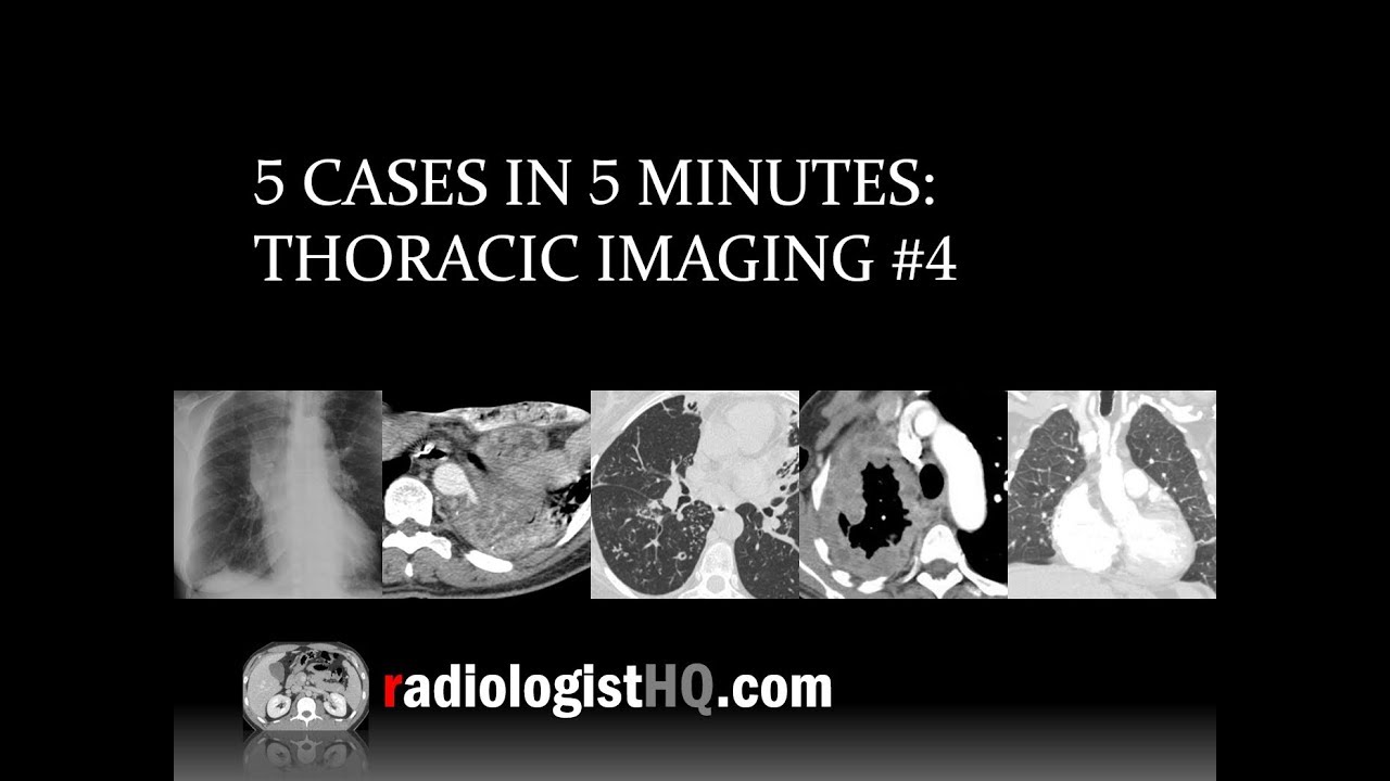 5 Cases in 5 Minutes: Thoracic #4 - YouTube