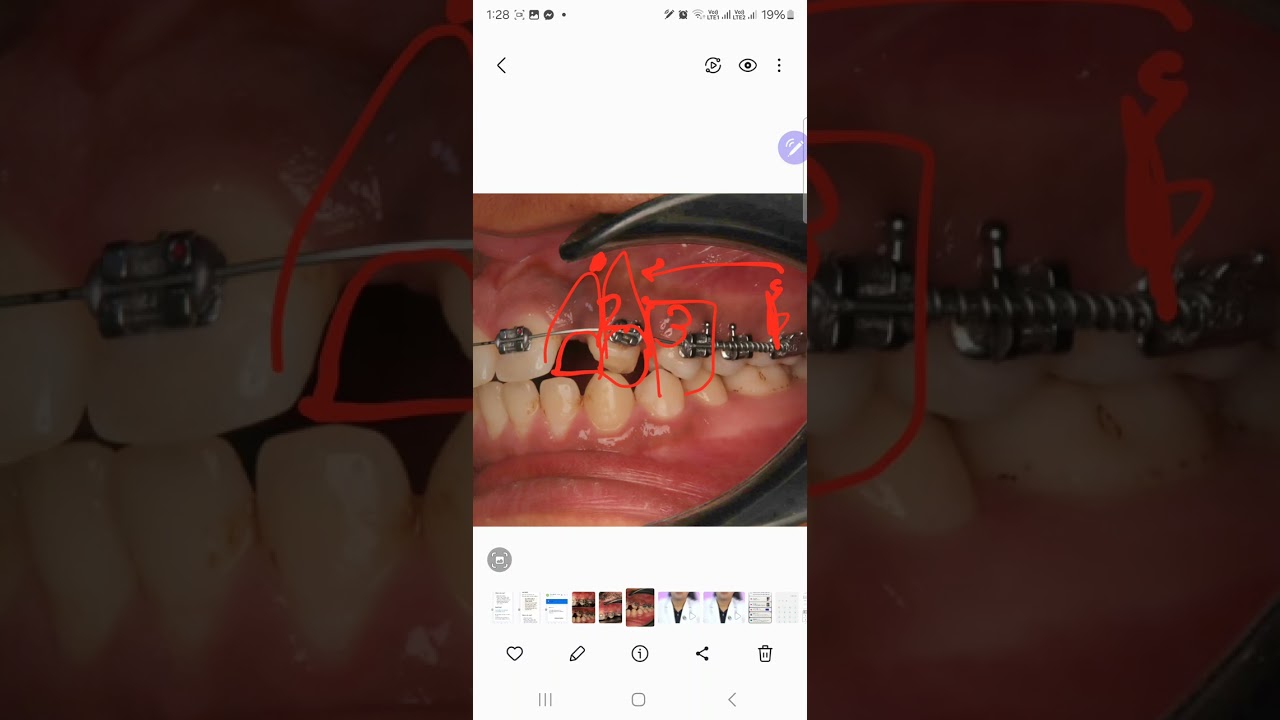 Trick in using open coil for mesializaion and distalization Dr.eslam samir