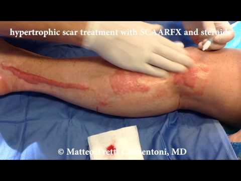 Hypertrophic scar treatment with steroids