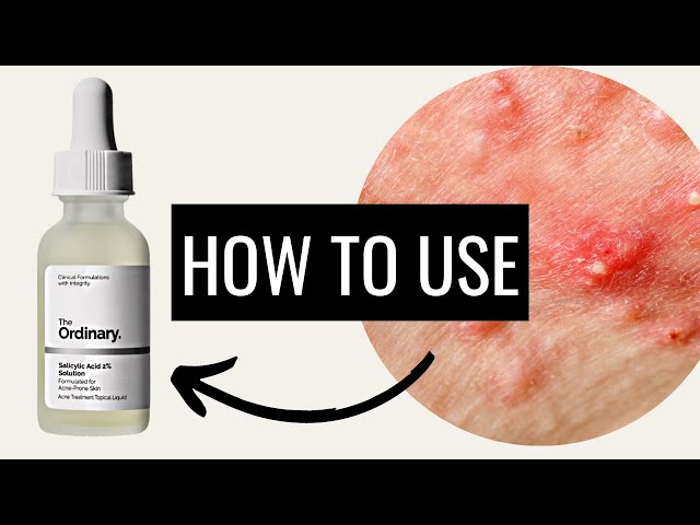 How To Use The Ordinary Salicylic Acid 2% Solution class=