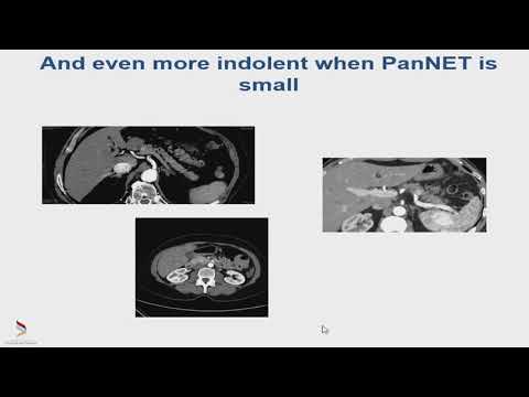 EBGH Torgiano 2018 Riscontro incidentale di lesioni solide pancreatiche di Stefano Partelli