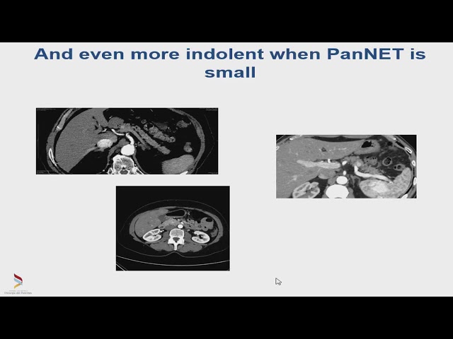 EBGH Torgiano 2018   Riscontro incidentale di lesioni solide pancreatiche di Stefano Partelli