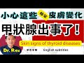 留意這些皮膚變化，可能顯示甲狀腺出問題了！skin signs of thyroid diseases