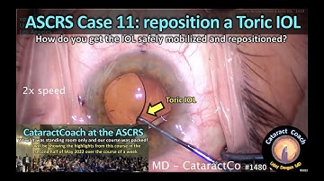 CataractCoach 1480: ASCRS case 11: reposition a toric IOL