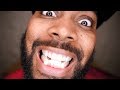 How I Fixed My Missing Tooth With Invisalign | iPodKingCarter