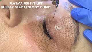 Plasma Pen Eye Lift