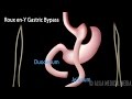 Roux en-Y Gastric Bypass, with Introduction on Body Mass Index, Animation.