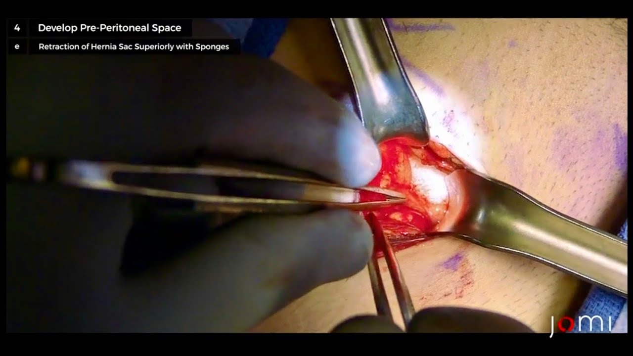 Laparoscopic Transabdominal Preperitoneal Inguinal Hernia Repair