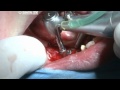 Implanturi dentare- Clinica Implantodent Constanta - YouTube