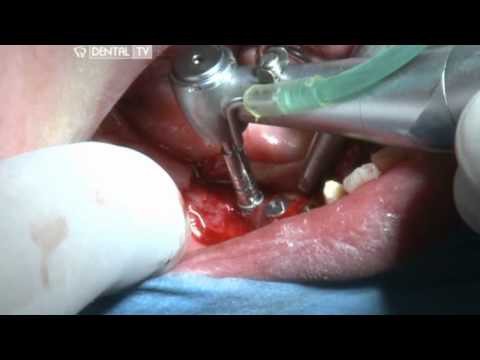 Video: Implant Endosteal: Tipuri și Proceduri De Implant Dentar