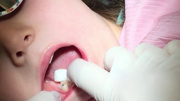 Advantage Arrest - Silver Diamine Fluoride : Pediatric Application | Dr. Jeanette MacLean, DDS