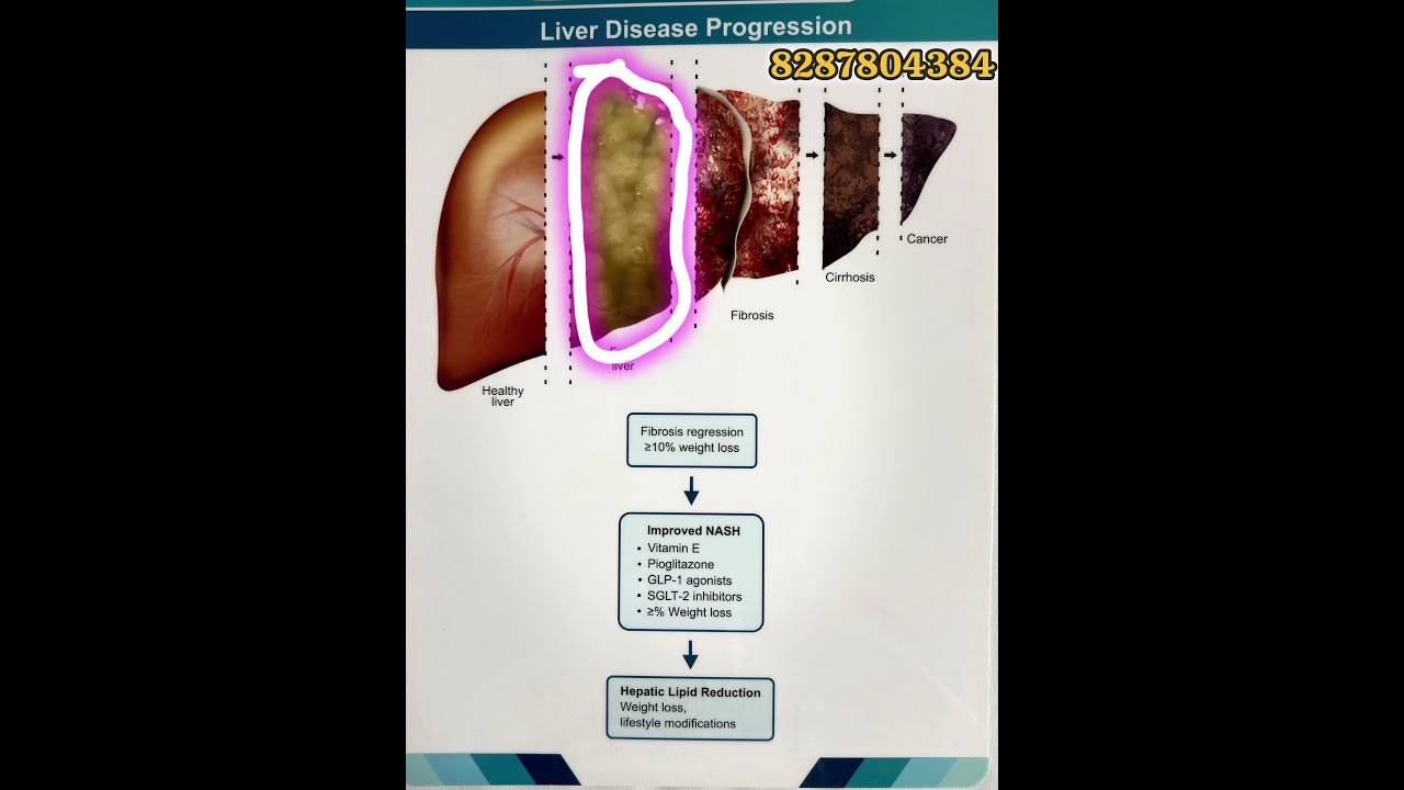What is fatty liver ,how to cure it with excercise, nutrition 